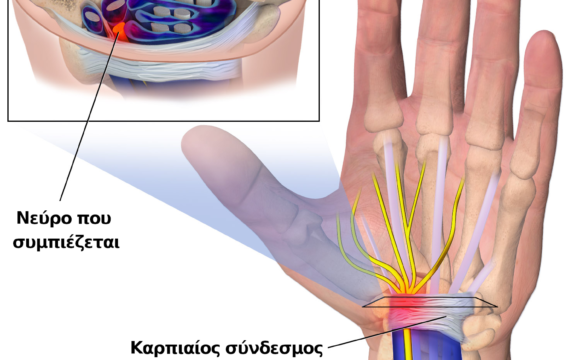 ΣΥΝΔΡΟΜΟ ΚΑΡΠΙΑΙΟΥ ΣΩΛΗΝΑ ΣΤΗΝ ΕΓΚΥΜΟΣΥΝΗ