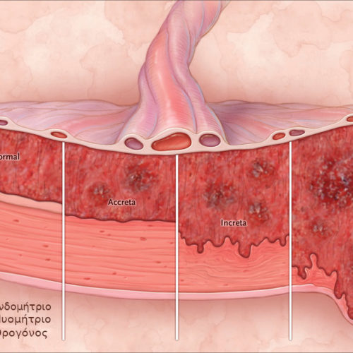 Abnormally invasive placenta