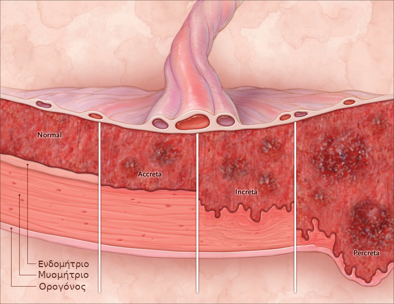 Abnormally invasive placenta