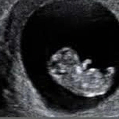 Early pregnancy scan