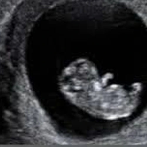 EARLY PREGNANCY SCAN