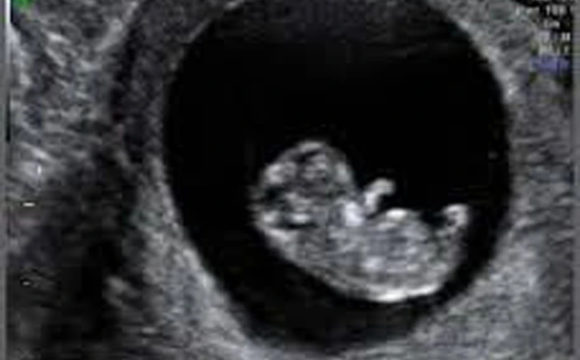 Early pregnancy scan