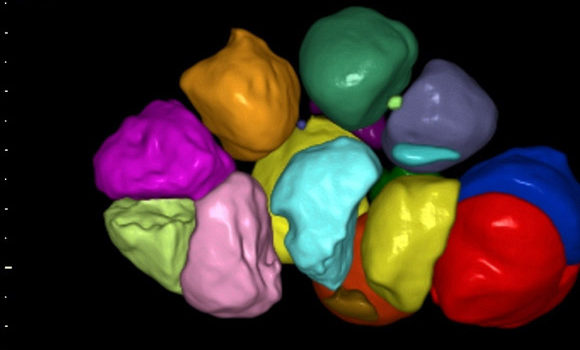 Polycystic ovaries syndrome