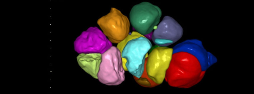 POLYCYSTIC OVARIES SYNDROME