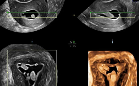 SONOHYSTEROGRAM