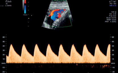 Fetal doppler scan