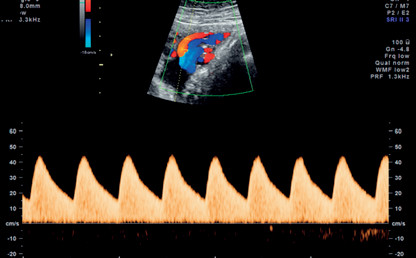 FETAL DOPPLERS SCAN