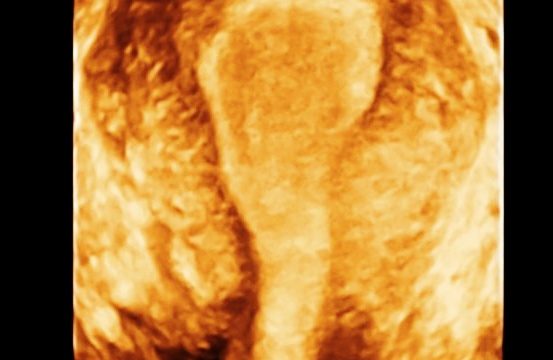 GYNECOLOGICAL SCAN