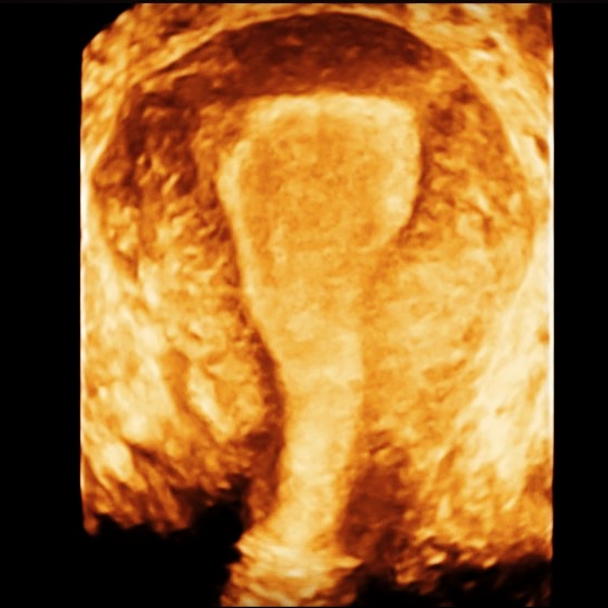 Gynecological scan