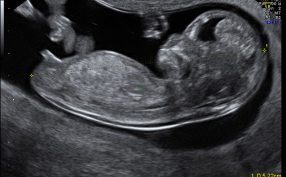 NUCHAL TRANSLUCENCY SCAN