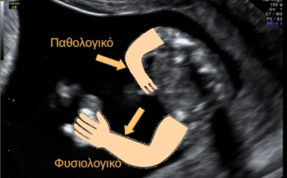 ΠΡΟΓΕΝΝΗΤΙΚΟΣ ΕΛΕΓΧΟΣ: Σκελετική ανωμαλία εμβρύου στο 1ο τρίμηνο της εγκυμοσύνης