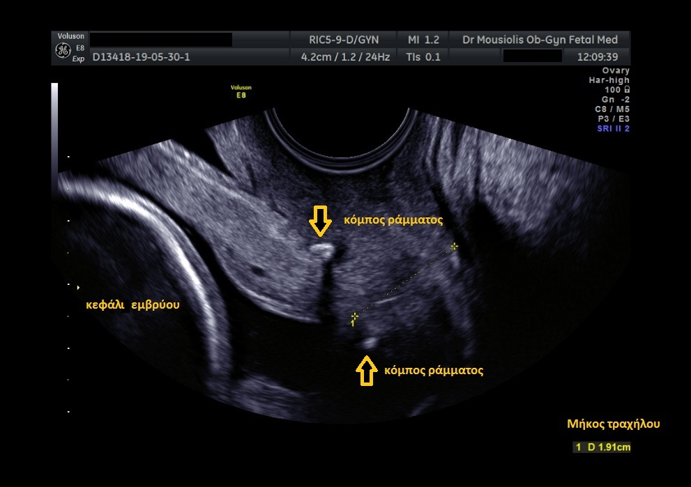 Cervix appearance after cerclage