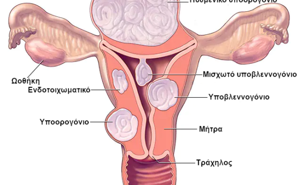 Υποβλεννογόνια ινομυώματα