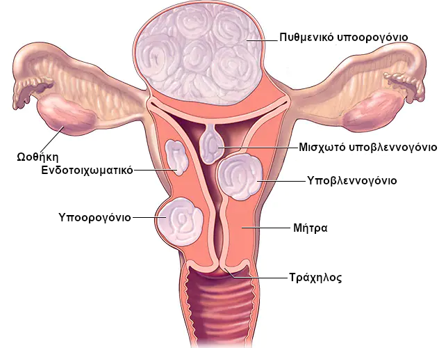 ινομυώματα Υποβλεννογόνια ινομυώματα