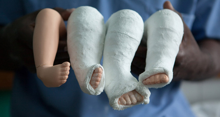 clubfoot Προγεννητικός έλεγχος: Ραιβοποδία (στρεβλοποδία)