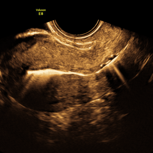 Salpingography by ultrasound (HyFoSy)