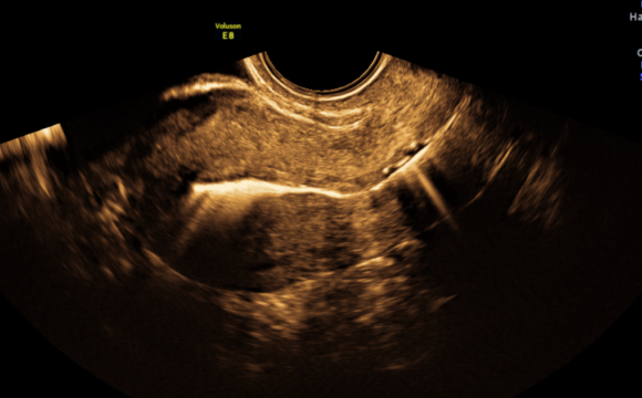 Salpingography by ultrasound (HyFoSy)
