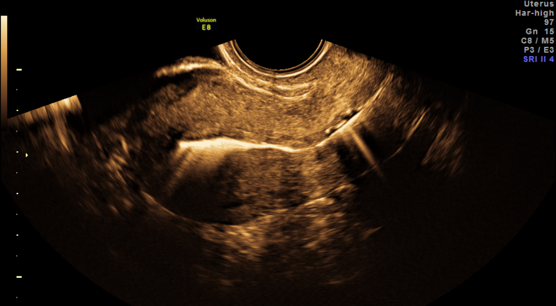 Salpingography by ultrasound (HyFoSy)