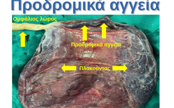 ΠΑΡΟΥΣΙΑΣΗ ΠΕΡΙΣΤΑΤΙΚΟΥ: Προδρομικά αγγεία